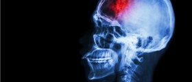 Periodontitis And Your Brain: Can Advanced Periodontal (Gum) Disease Cause A Stroke?